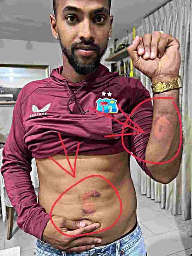 Image for 'The after effects' - After the fifth T20 match, Nicholas Pooran showed the scars on his?body?